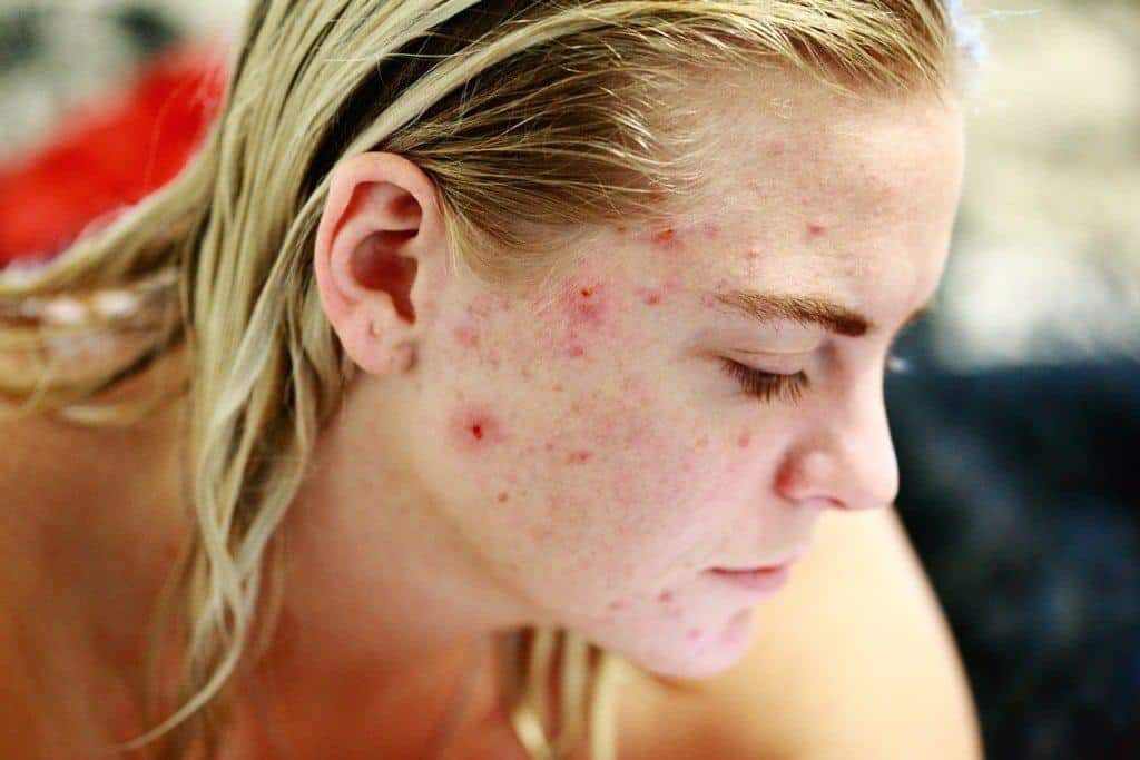 Coconut Oil as Acne Fighter