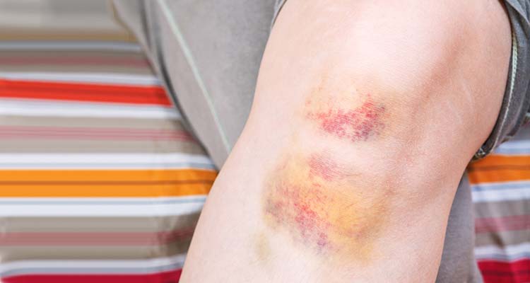 Bruised knees from kneeling