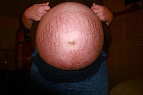 stretchmark