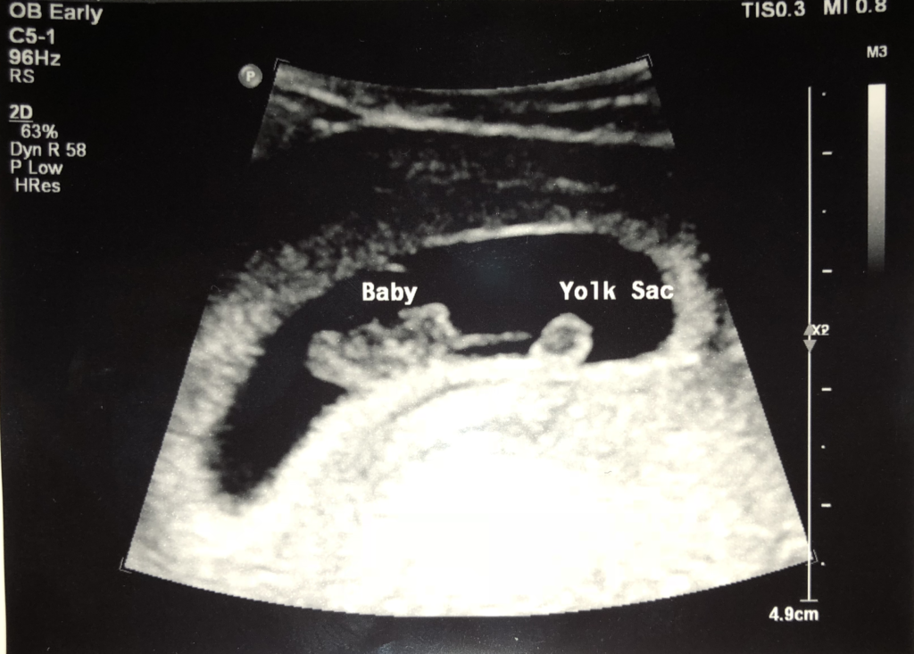 8 weeks pregnant ultrasound
