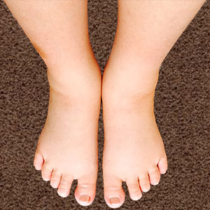 swollen feet from pregnancy