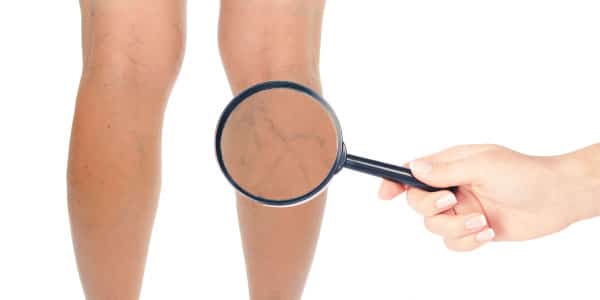 varicose veins under a magnifying glass