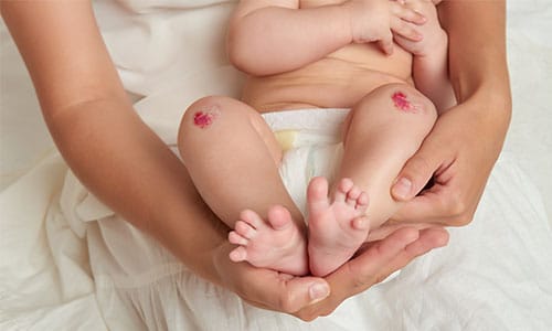 baby with bloody knees from crawling on tiles