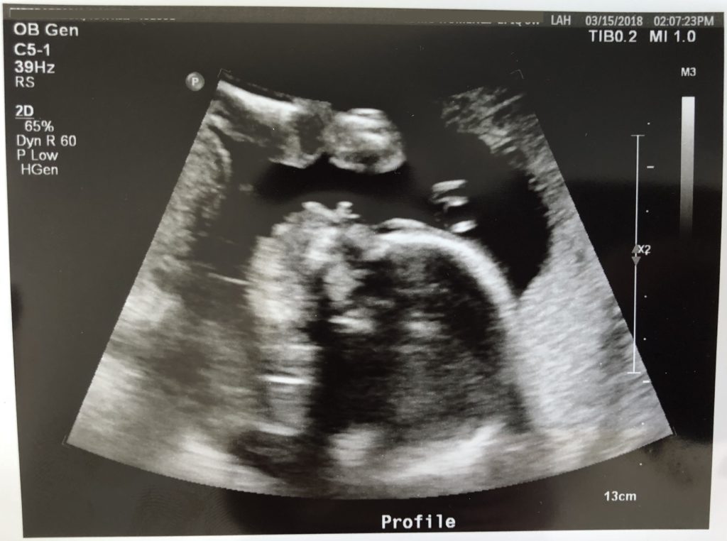 20 weeks pregnant ultrasound