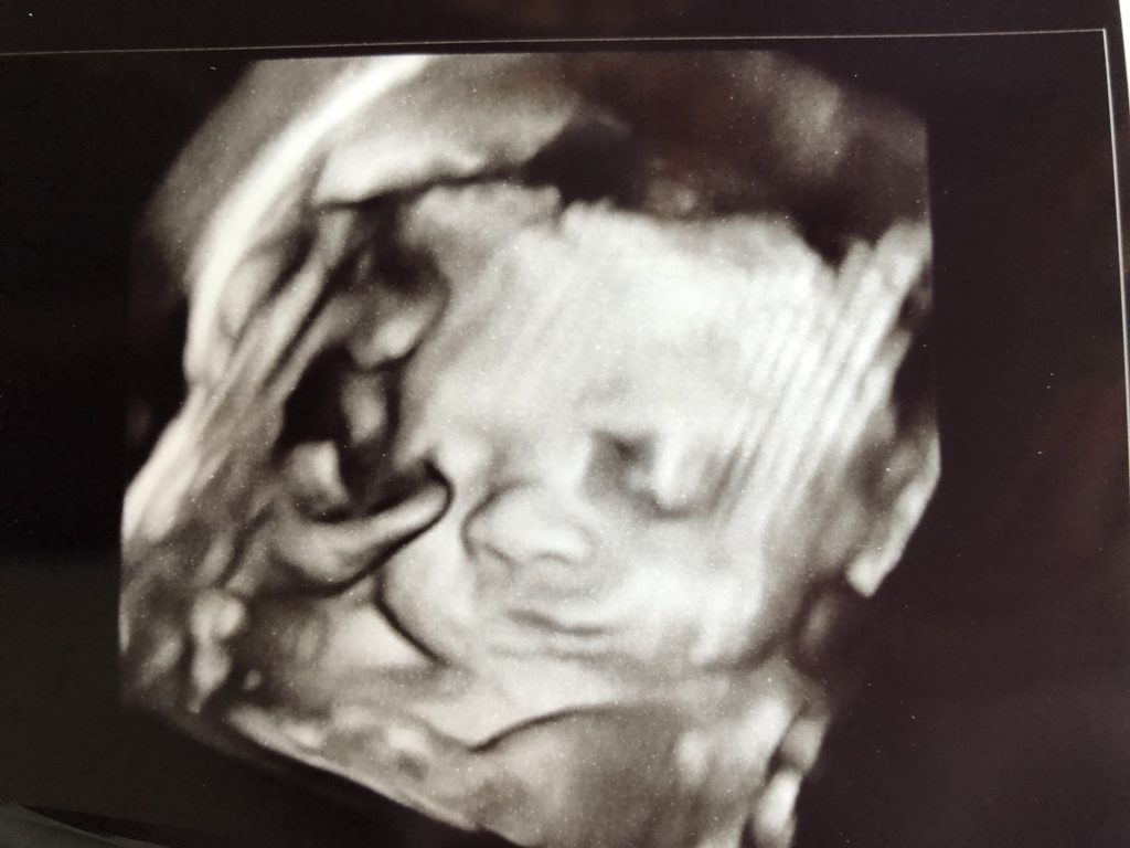 26 weeks pregnant ultrasound