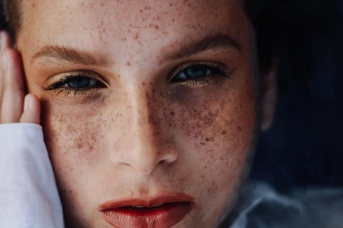 face with freckles